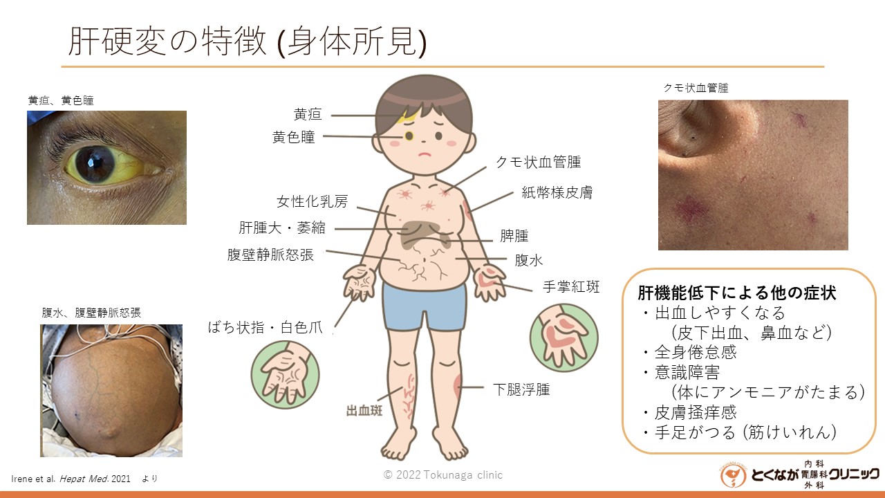 肝硬変　画像 肝硬変 - とくなが内科胃腸科外科クリニック | 熊本市 東区 内視鏡 (胃カメラ 大腸カメラ) かかりつけ医