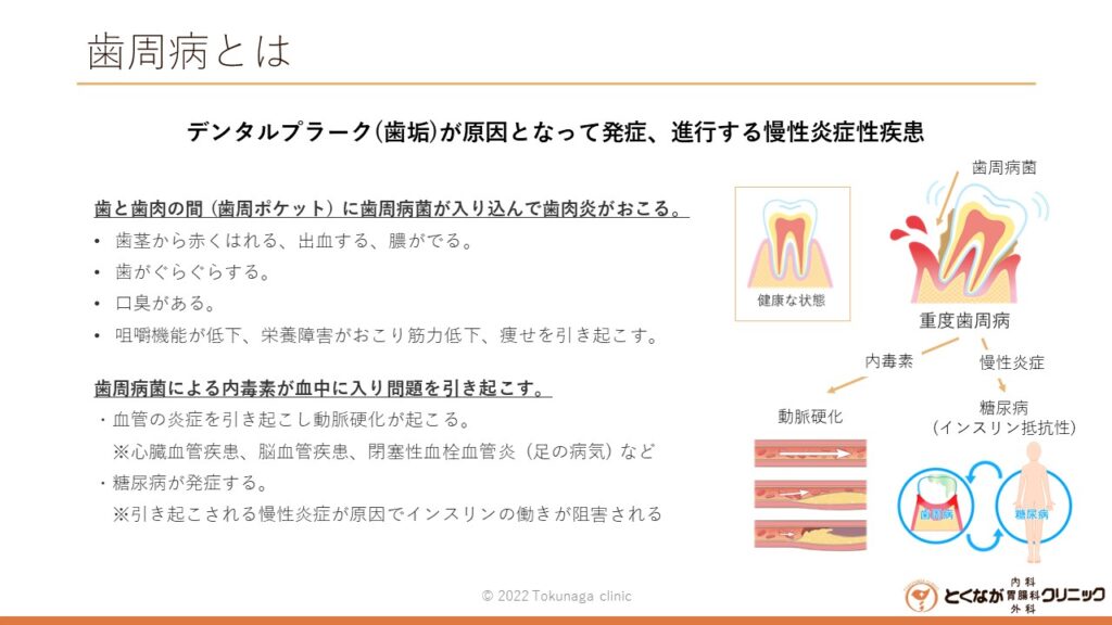 歯周病 のイメージ画像