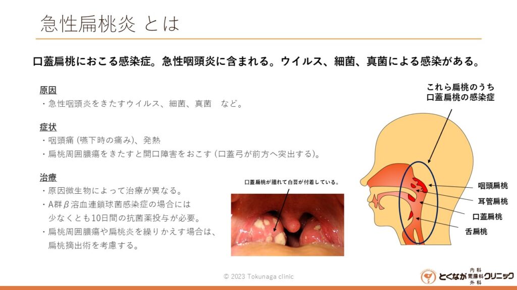 急性扁桃炎 とは - とくなが内科胃腸科外科クリニック | 熊本市 東区 胃カメラ 大腸カメラ かかりつけ医