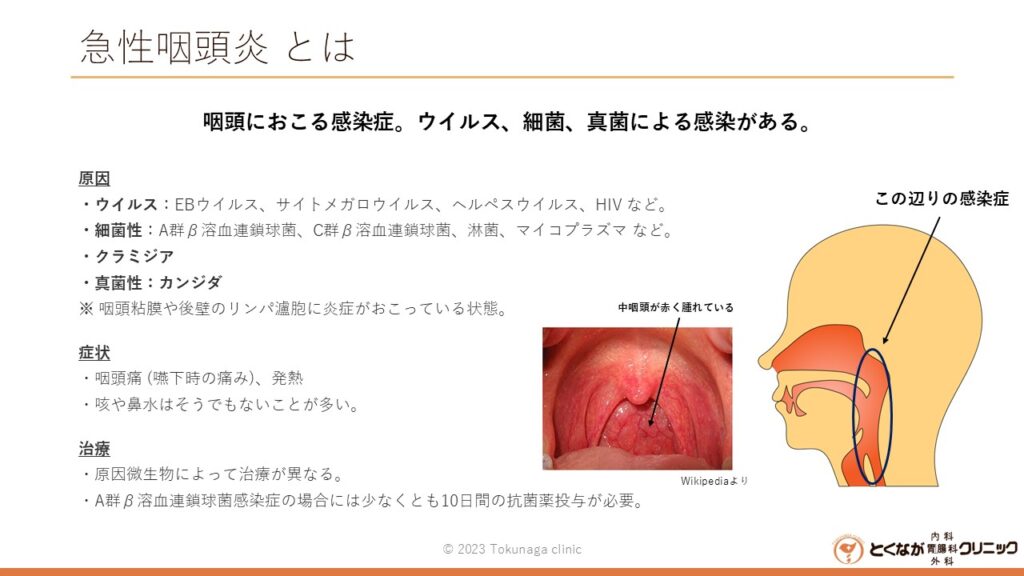 急性咽頭炎　のイメージ画像