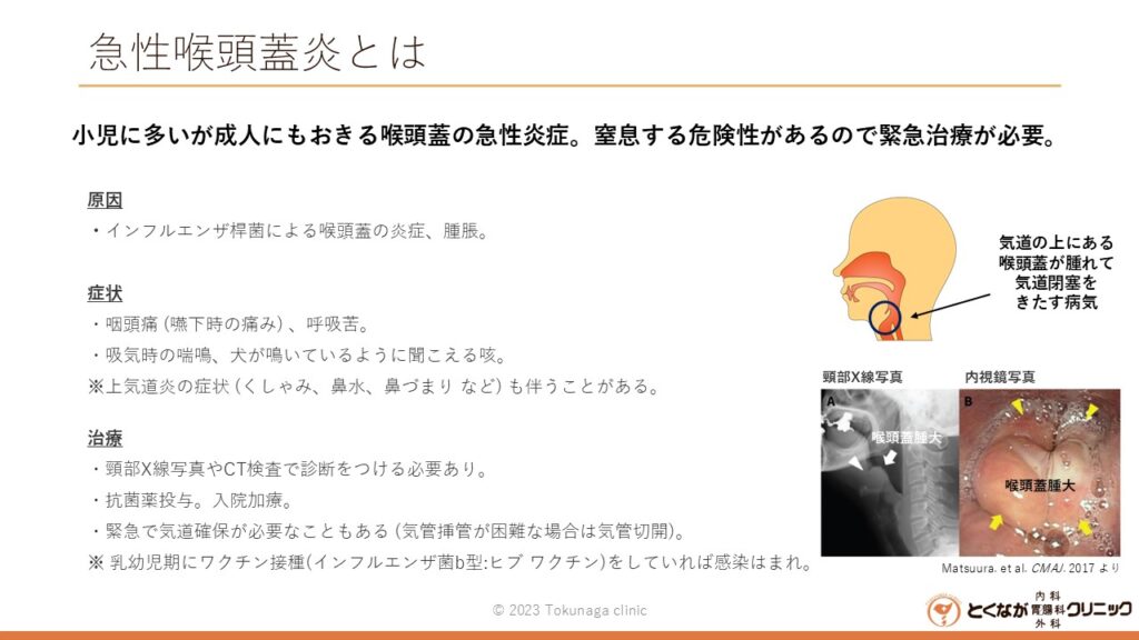 急性喉頭蓋炎　のイメージ画像
